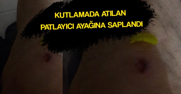 Patlayıcı ayağına saplandı